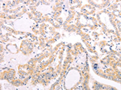The image on the left is immunohistochemistry of paraffin-embedded Human thyroid cancer tissue using VHL Antibody(VHL Antibody) at dilution 1/40, on the right is treated with fusion protein. (Original magnification: ×200)Rabbit anti-Human VHL Polyclonal Antibody