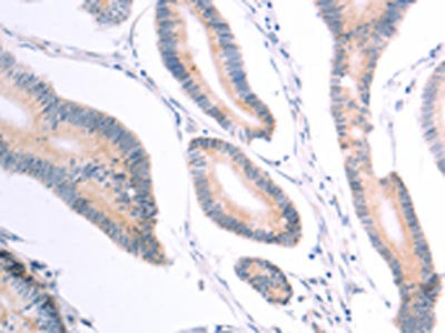 The image on the left is immunohistochemistry of paraffin-embedded Human colon cancer tissue using the antibody Antibody) at dilution 1/40, on the right is treated with fusion protein. (Original magnification: ×200)Rabbit anti-Human VHL Polyclonal Antibody