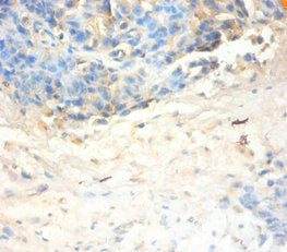 Immunohistochemistry of paraffin-embedded human ovarian cancer using the antibody at dilution of 1:100Rabbit anti-Human SLPI Polyclonal Antibody