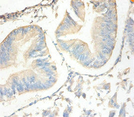Immunohistochemistry of paraffin-embedded human endometrial cancer using SLPI Antibody at dilution of 1:100Rabbit anti-Human SLPI Polyclonal Antibody