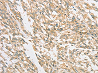 The image on the left is immunohistochemistry of paraffin-embedded Human esophagus cancer tissue using PRKAA1 Antibody(PRKAA1 Antibody) at dilution 1/80, on the right is treated with synthetic peptide. (Original magnification: ×200)Rabbit anti-Human PRKAA1 Polyclonal Antibody