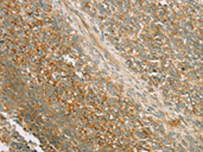 The image on the left is immunohistochemistry of paraffin-embedded Human ovarian cancer tissue using the antibody Antibody) at dilution 1/80, on the right is treated with synthetic peptide. (Original magnification: ×200)Rabbit anti-Human PRKAA1 Polyclonal Antibody