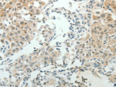 The image on the left is immunohistochemistry of paraffin-embedded Human lung cancer tissue using NDRG2 Antibody(NDRG2 Antibody) at dilution 1/50, on the right is treated with synthetic peptide. (Original magnification: ×200)Rabbit anti-Human NDRG2 Polyclonal Antibody