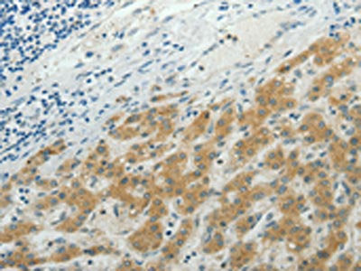 The image on the left is immunohistochemistry of paraffin-embedded Human liver cancer tissue using the antibody Antibody) at dilution 1/50, on the right is treated with synthetic peptide. (Original magnification: ×200)Rabbit anti-Human NDRG2 Polyclonal Antibody