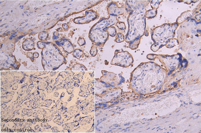 Immunocytochemistry analysis of human colon cancer using TFRC Antibody at dilution of 1:100Rabbit anti-Human TFRC Polyclonal Antibody