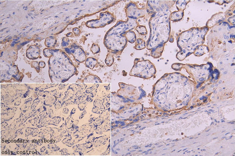 Immunocytochemistry analysis of human colon cancer using TFRC Antibody at dilution of 1:100Rabbit anti-Human TFRC Polyclonal Antibody