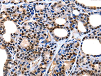The image on the left is immunohistochemistry of paraffin-embedded Human thyroid cancer tissue using YWHAE Antibody(YWHAE Antibody) at dilution 1/5, on the right is treated with fusion protein. (Original magnification: ×200)Rabbit anti-Human YWHAE Polyclonal Antibody
