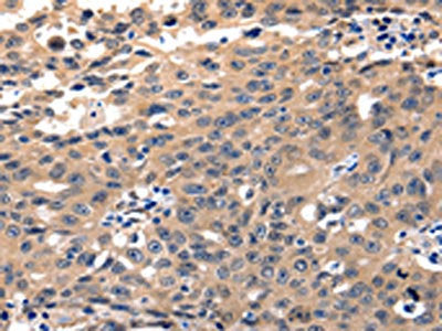 The image on the left is immunohistochemistry of paraffin-embedded Human ovarian cancer tissue using the antibody Antibody) at dilution 1/5, on the right is treated with fusion protein. (Original magnification: ×200)Rabbit anti-Human YWHAE Polyclonal Antibody