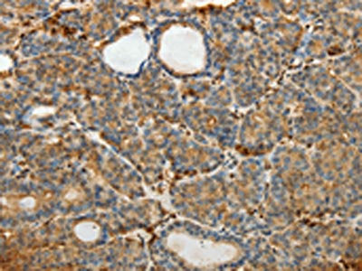 The image on the left is immunohistochemistry of paraffin-embedded Human thyroid cancer tissue using SULT1E1 Antibody(SULT1E1 Antibody) at dilution 1/30, on the right is treated with fusion protein. (Original magnification: ×200)Rabbit anti-Human SULT1E1 Polyclonal Antibody