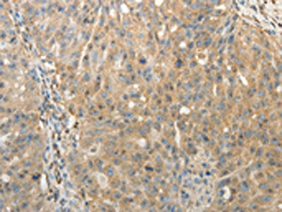 The image on the left is immunohistochemistry of paraffin-embedded Human ovarian cancer tissue using the antibody Antibody) at dilution 1/30, on the right is treated with fusion protein. (Original magnification: ×200)Rabbit anti-Human SULT1E1 Polyclonal Antibody