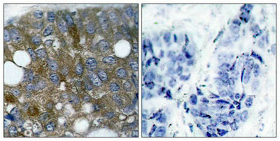 Immunohistochemical analysis of paraffin-embedded human breast carcinoma tissue using HSP27(Phospho-Ser15) Antibody(left) or the same antibody preincubated with blocking peptide(right).Rabbit anti-Human HSPB1 Polyclonal Antibody