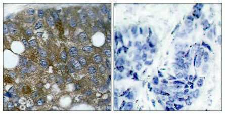 Immunohistochemical analysis of paraffin-embedded human breast carcinoma tissue using HSP27(Phospho-Ser15) Antibody(left) or the same antibody preincubated with blocking peptide(right).Rabbit anti-Human HSPB1 Polyclonal Antibody