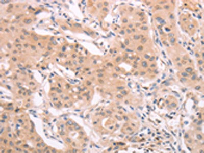 The image on the left is immunohistochemistry of paraffin-embedded Human breast cancer tissue using the antibody Antibody) at dilution 1/40, on the right is treated with synthetic peptide. (Original magnification: ×200)