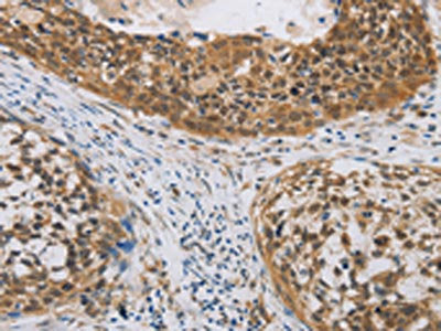 The image on the left is immunohistochemistry of paraffin-embedded Human cervical cancer tissue using CYFIP2 Antibody(CYFIP2 Antibody) at dilution 1/25, on the right is treated with fusion protein. (Original magnification: ×200)Rabbit anti-Human CYFIP2 Polyclonal Antibody