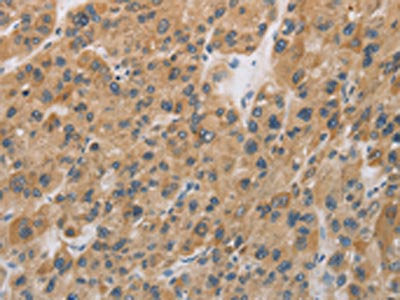 The image on the left is immunohistochemistry of paraffin-embedded Human liver cancer tissue using the antibody Antibody) at dilution 1/25, on the right is treated with fusion protein. (Original magnification: ×200)Rabbit anti-Human CYFIP2 Polyclonal Antibody