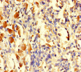 Immunohistochemistry of paraffin-embedded human melanoma using TGFA Antibody at dilution of 1:100Rabbit anti-Human TGFA Polyclonal Antibody