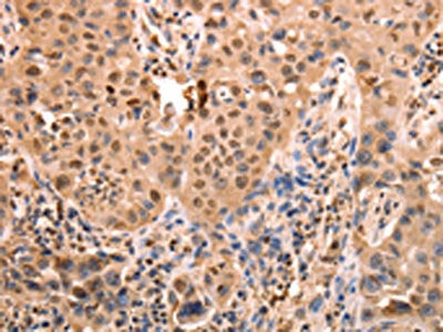 The image on the left is immunohistochemistry of paraffin-embedded Human lung cancer tissue using ACO2 Antibody(ACO2 Antibody) at dilution 1/30, on the right is treated with synthetic peptide. (Original magnification: ×200)