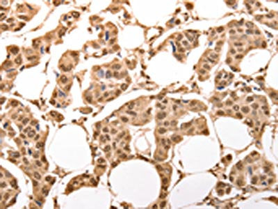 The image on the left is immunohistochemistry of paraffin-embedded Human breast cancer tissue using the antibody Antibody) at dilution 1/30, on the right is treated with synthetic peptide. (Original magnification: ×200)