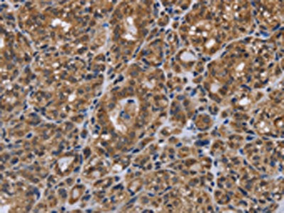 The image on the left is immunohistochemistry of paraffin-embedded Human thyroid cancer tissue using the antibody Antibody) at dilution 1/40, on the right is treated with fusion protein. (Original magnification: ×200)Rabbit anti-Human GALK1 Polyclonal Antibody