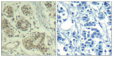 Immunohistochemical analysis of paraffin-embedded human breast carcinoma tissue using MDM2(Phospho-Ser166) Antibody(left) or the same antibody preincubated with blocking peptide(right).