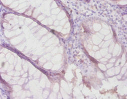 Immunohistochemistry of paraffin-embedded human colon cancer using the antibody at dilution of 1:100Rabbit anti-Human TIMP4 Polyclonal Antibody
