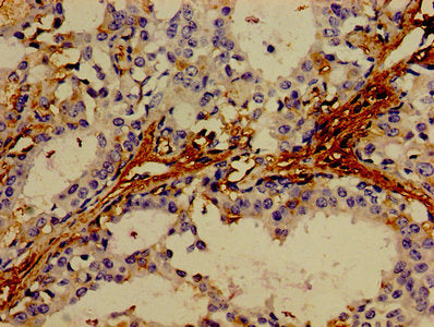 Immunohistochemistry of paraffin-embedded human breast cancer using TNF Antibody at dilution of 1:100Rabbit anti-Human TNF Polyclonal Antibody