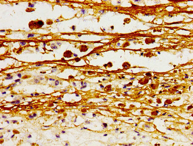 Immunohistochemistry of paraffin-embedded human melanoma using L1CAM Antibody at dilution of 1:100