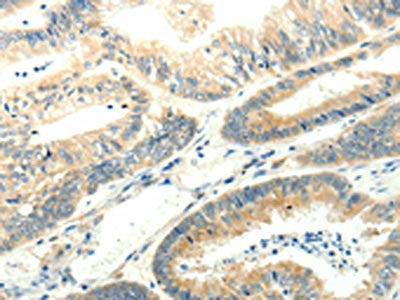 The image on the left is immunohistochemistry of paraffin-embedded Human colon cancer tissue using SYT5 Antibody(SYT5 Antibody) at dilution 1/15, on the right is treated with fusion protein. (Original magnification: ×200)Rabbit anti-Human SYT5 Polyclonal Antibody