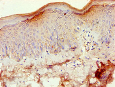 Immunohistochemistry of paraffin-embedded human skin tissue using MMP3 Antibody at dilution of 1:100Rabbit anti-Human MMP3 Polyclonal Antibody