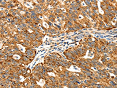 The image on the left is immunohistochemistry of paraffin-embedded Human ovarian cancer tissue using SSTR1 Antibody(SSTR1 Antibody) at dilution 1/40, on the right is treated with synthetic peptide. (Original magnification: ×200)Rabbit anti-Human SSTR1 Polyclonal Antibody