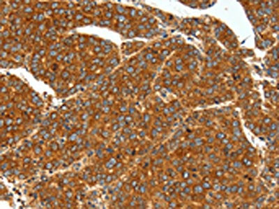 The image on the left is immunohistochemistry of paraffin-embedded Human liver cancer tissue using the antibody Antibody) at dilution 1/40, on the right is treated with synthetic peptide. (Original magnification: ×200)Rabbit anti-Human SSTR1 Polyclonal Antibody