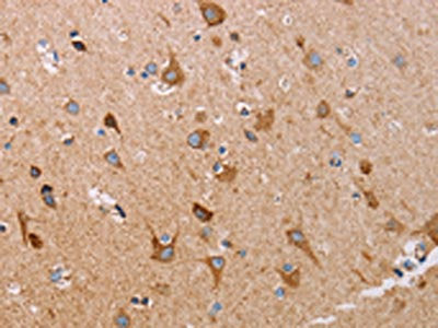 The image on the left is immunohistochemistry of paraffin-embedded Human brain tissue using the antibody Antibody) at dilution 1/15, on the right is treated with fusion protein. (Original magnification: ×200)