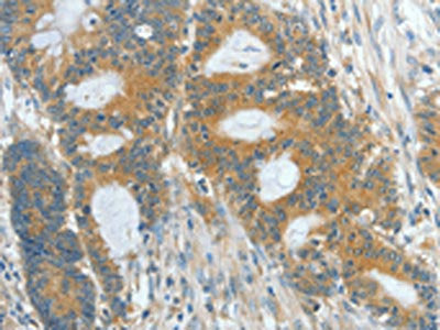 The image on the left is immunohistochemistry of paraffin-embedded Human colon cancer tissue using ASPA Antibody(ASPA Antibody) at dilution 1/60, on the right is treated with fusion protein. (Original magnification: ×200)Rabbit anti-Human ASPA Polyclonal Antibody
