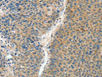 The image on the left is immunohistochemistry of paraffin-embedded Human liver cancer tissue using the antibody Antibody) at dilution 1/60, on the right is treated with fusion protein. (Original magnification: ×200)