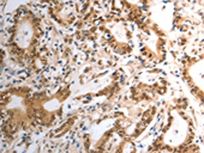 The image on the left is immunohistochemistry of paraffin-embedded Human gastric cancer tissue using RAD50 Antibody(RAD50 Antibody) at dilution 1/40, on the right is treated with synthetic peptide. (Original magnification: ×200)Rabbit anti-Human RAD50 Polyclonal Antibody