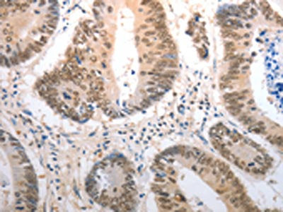 The image on the left is immunohistochemistry of paraffin-embedded Human colon cancer tissue using the antibody Antibody) at dilution 1/40, on the right is treated with synthetic peptide. (Original magnification: ×200)Rabbit anti-Human RAD50 Polyclonal Antibody
