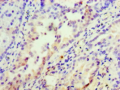 Immunohistochemistry of paraffin-embedded human lung cancer using INHBA Antibody at dilution of 1:100