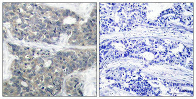Immunohistochemical analysis of paraffin-embedded human breast carcinoma tissue using p70 S6 Kinase(Phospho-Thr421) Antibody(left) or the same antibody preincubated with blocking peptide(right).Rabbit anti-Human RPS6KB1 Polyclonal Antibody