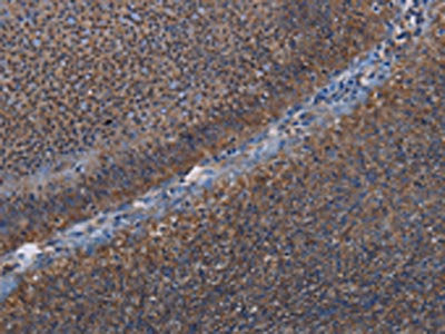 The image on the left is immunohistochemistry of paraffin-embedded Human rectal cancer tissue using the antibody Antibody) at dilution 1/50, on the right is treated with fusion protein. (Original magnification: ×200)