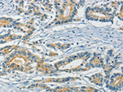 The image on the left is immunohistochemistry of paraffin-embedded Human colon cancer tissue using ASAH2 Antibody(ASAH2 Antibody) at dilution 1/40, on the right is treated with fusion protein. (Original magnification: ×200)Rabbit anti-Human ASAH2 Polyclonal Antibody