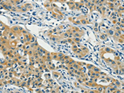 The image on the left is immunohistochemistry of paraffin-embedded Human lung cancer tissue using the antibody Antibody) at dilution 1/40, on the right is treated with fusion protein. (Original magnification: ×200)