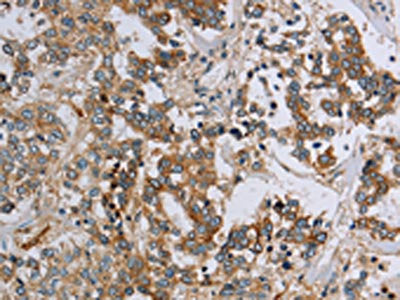 The image on the left is immunohistochemistry of paraffin-embedded Human liver cancer tissue using HSD17B14 Antibody(HSD17B14 Antibody) at dilution 1/30, on the right is treated with fusion protein. (Original magnification: ×200)Rabbit anti-Human HSD17B14 Polyclonal Antibody