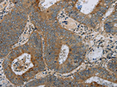 The image on the left is immunohistochemistry of paraffin-embedded Human colon cancer tissue using the antibody Antibody) at dilution 1/30, on the right is treated with fusion protein. (Original magnification: ×200)Rabbit anti-Human HSD17B14 Polyclonal Antibody