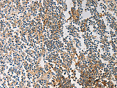 The image on the left is immunohistochemistry of paraffin-embedded Human tonsil tissue using PRMT5 Antibody(PRMT5 Antibody) at dilution 1/20, on the right is treated with synthetic peptide. (Original magnification: ×200)Rabbit anti-Human PRMT5 Polyclonal Antibody