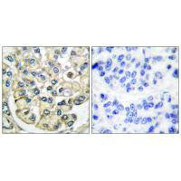 Immunohistochemical analysis of paraffin-embedded human breast carcinoma tissue using FGFR2 antibody.Rabbit anti-Human FGFR2 Polyclonal Antibody