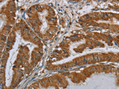 The image on the left is immunohistochemistry of paraffin-embedded Human esophagus cancer tissue using CSH1 Antibody(CSH1 Antibody) at dilution 1/40, on the right is treated with fusion protein. (Original magnification: ×200)Rabbit anti-Human CSH1 Polyclonal Antibody