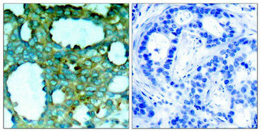 Immunohistochemical analysis of paraffin-embedded human breast carcinoma tissue using PAK1(Phospho-Thr212) Antibody(left) or the same antibody preincubated with blocking peptide(right).Rabbit anti-Human PAK1 Polyclonal Antibody