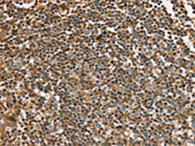 The image on the left is immunohistochemistry of paraffin-embedded Human tonsil tissue using PLS3 Antibody(PLS3 Antibody) at dilution 1/30, on the right is treated with fusion protein. (Original magnification: ×200)Rabbit anti-Human PLS3 Polyclonal Antibody