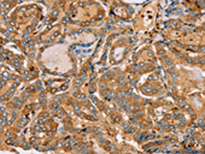 The image on the left is immunohistochemistry of paraffin-embedded Human thyroid cancer tissue using the antibody Antibody) at dilution 1/30, on the right is treated with fusion protein. (Original magnification: ×200)Rabbit anti-Human PLS3 Polyclonal Antibody