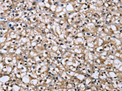 The image on the left is immunohistochemistry of paraffin-embedded Human prostate cancer tissue using the antibody Antibody) at dilution 1/25, on the right is treated with fusion protein. (Original magnification: ×200)Rabbit anti-Human DYNLL1 Polyclonal Antibody